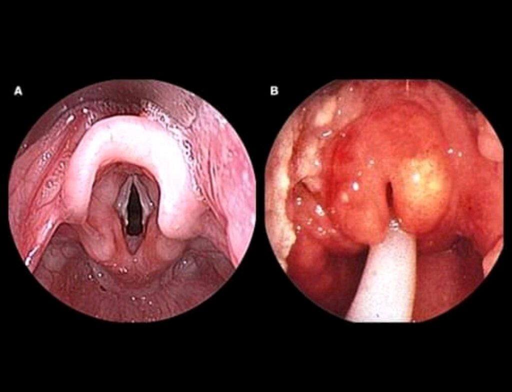 image epiglottitis